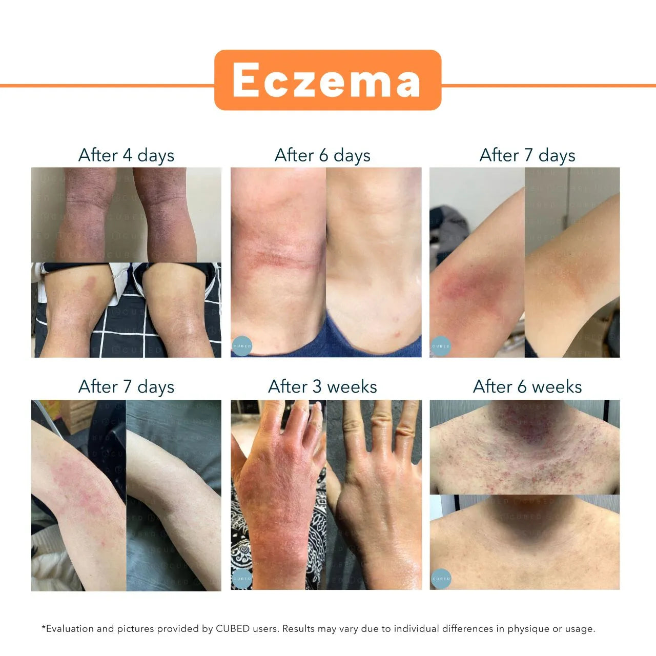 Body Eczema Relief Trio (Limited Time Upgrade Offer)  (Pre-order ship on 4th December)