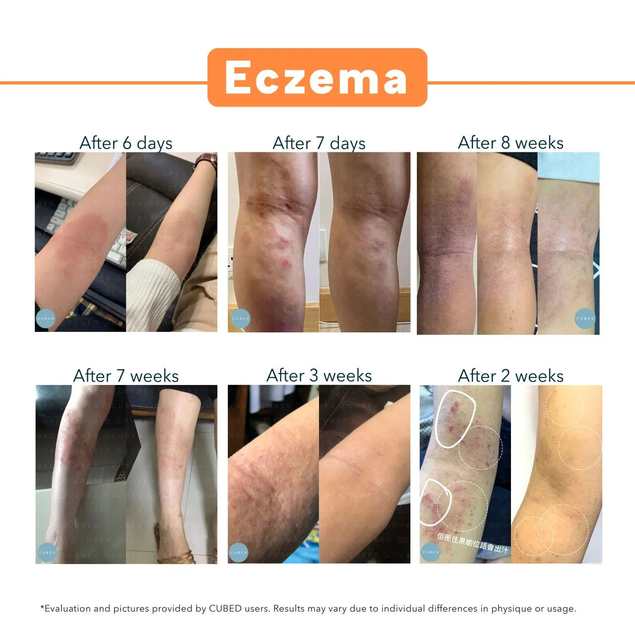 Body Eczema Relief Trio (Limited Time Upgrade Offer)  (Pre-order ship on 4th December)