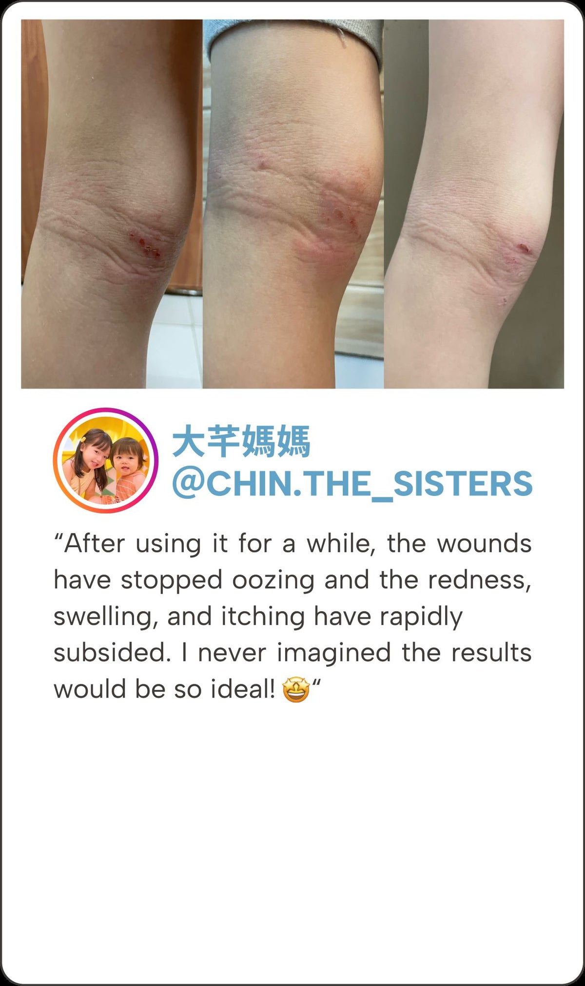 CUBED SKINCARE | Eczema, Dermatitis Atopic, and Psoriasis Relief ...